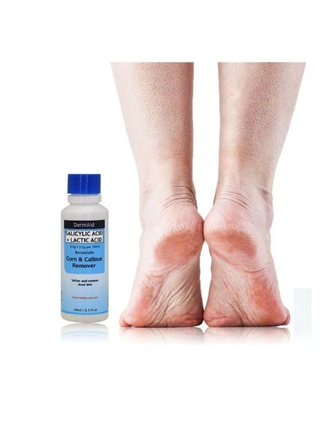 Dermaid Corn and Callous Remover (60ml) edamama